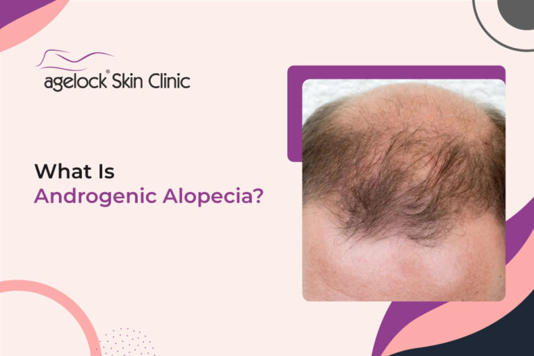 What Is Androgenic Alopecia?