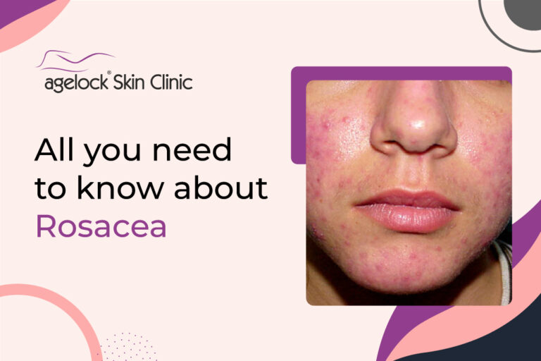 All you need to know about Rosacea