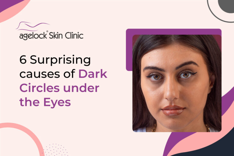 6 surprising causes of dark circles under the eyes