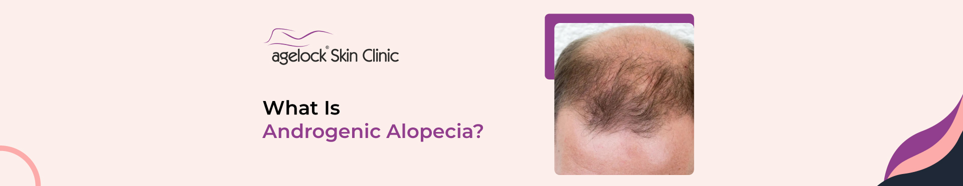 What Is Androgenic Alopecia? Causes, Treatment & Side Effects 