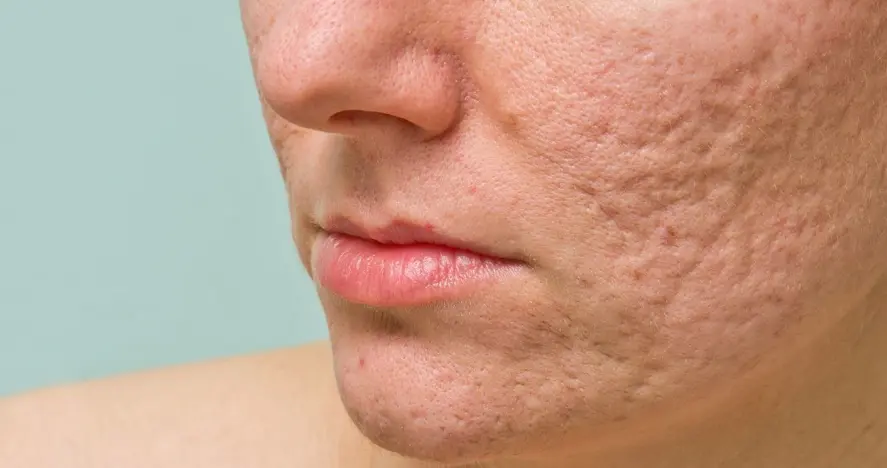 Acne Scars Treatment in Chandigarh