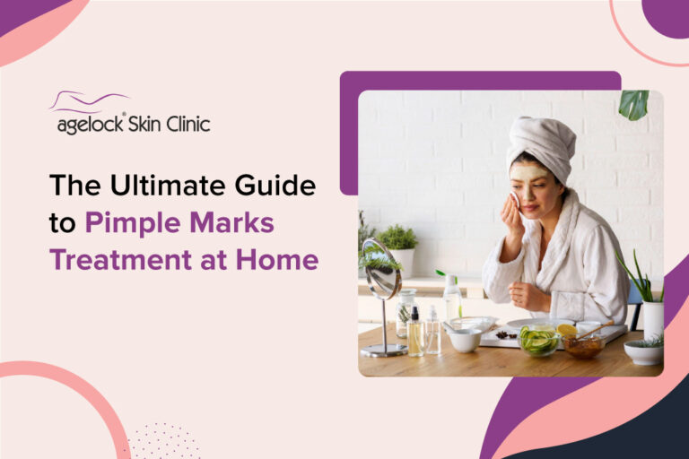 The Ultimate Guide to Pimple Marks Treatment at Home