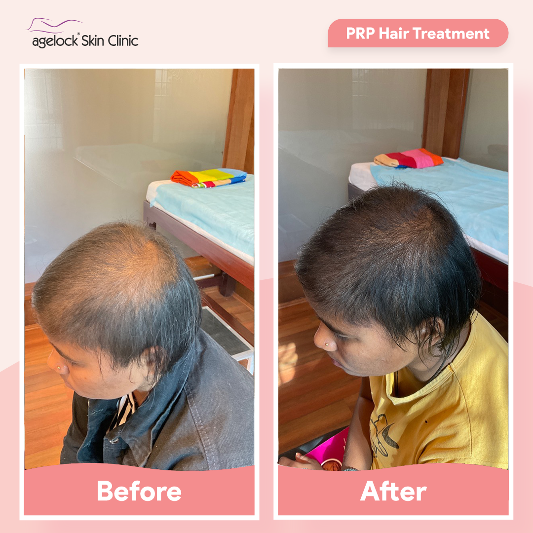 PRP Hair Treatment in Chandigarh PRP Hair Treatment in Chandigarh