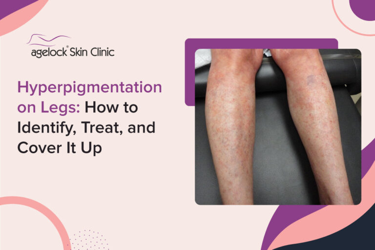 Hyperpigmentation on Legs: How to Identify, Treat, and Cover It Up