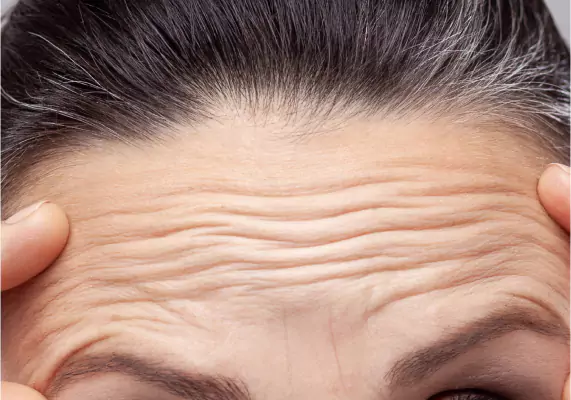 Anti Wrinkle Injection Treatment In Chandigarh Anti Wrinkle Injection Treatment In Chandigarh