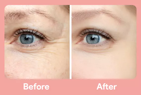 Anti Wrinkle Injection Treatment In Chandigarh Anti Wrinkle Injection Treatment In Chandigarh