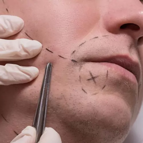 Beard Hair Transplant