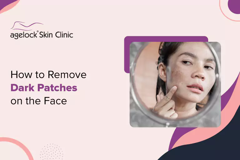 How -to -Remove -Dark -Patches -on -the- Face