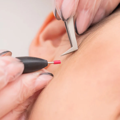 Hair Transplant Surgery Hair Transplant Surgery