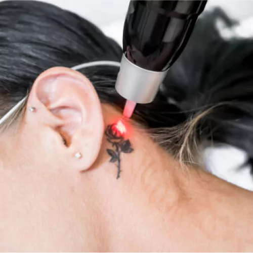PicoSure lasers