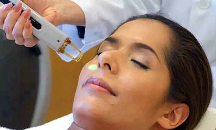 Laser Toning for Hyperpigmentation