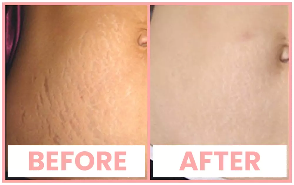 Prp Treatment For Stretch Mark Removal In Chandigarh Prp Treatment For Stretch Mark Removal In Chandigarh