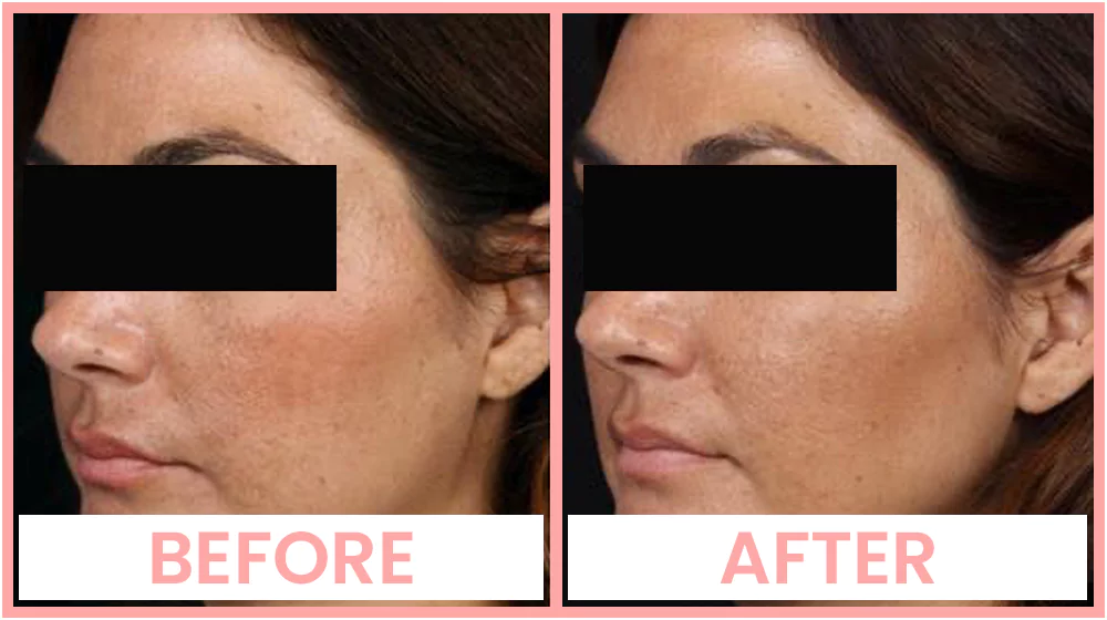 Cheek Enhancement in Chandigarh