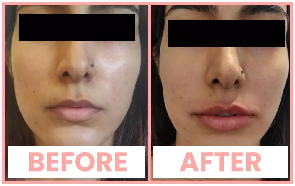 Lip enhancement Treatment In Chandigarh