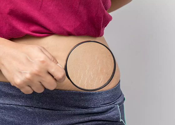 Stretch Marks Treatment In Chandigarh