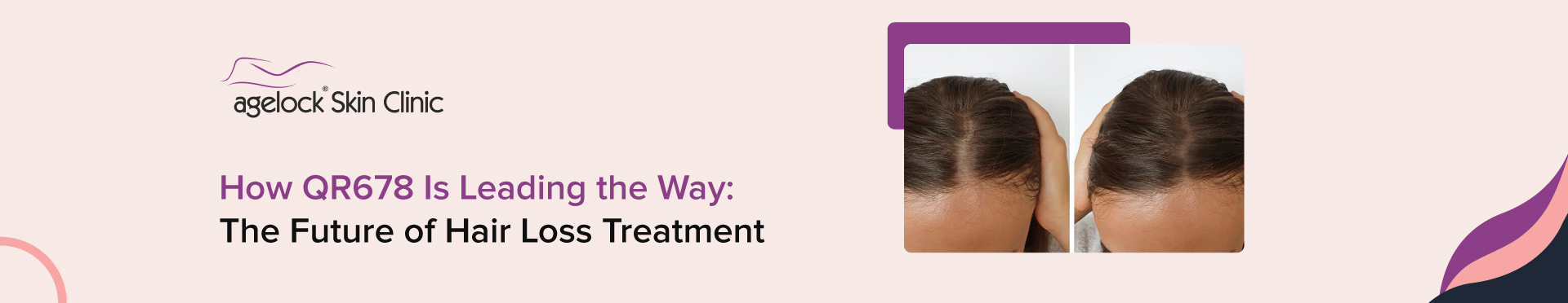 How QR678 Is Leading the Way: The Future of Hair Loss Treatment